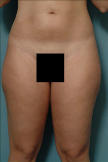 Liposuction Before Photo by Ellen Janetzke, MD; Bloomfield Hills, MI - Case 23845