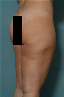 Liposuction Before Photo by Ellen Janetzke, MD; Bloomfield Hills, MI - Case 23845
