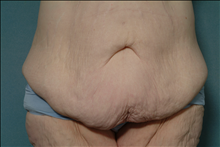 Tummy Tuck Before Photo by Ellen Janetzke, MD; Bloomfield Hills, MI - Case 23846