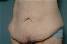 Tummy Tuck Before Photo by Ellen Janetzke, MD; Bloomfield Hills, MI - Case 23846