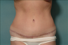 Tummy Tuck After Photo by Ellen Janetzke, MD; Bloomfield Hills, MI - Case 23847