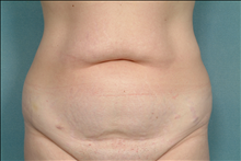 Tummy Tuck Before Photo by Ellen Janetzke, MD; Bloomfield Hills, MI - Case 23847