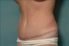 Tummy Tuck After Photo by Ellen Janetzke, MD; Bloomfield Hills, MI - Case 23847