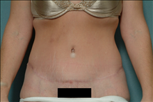 Tummy Tuck After Photo by Ellen Janetzke, MD; Bloomfield Hills, MI - Case 23848