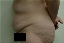 Tummy Tuck Before Photo by Ellen Janetzke, MD; Bloomfield Hills, MI - Case 23850