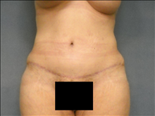 Tummy Tuck After Photo by Ellen Janetzke, MD; Bloomfield Hills, MI - Case 23852