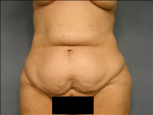 Tummy Tuck Before Photo by Ellen Janetzke, MD; Bloomfield Hills, MI - Case 23852