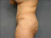 Tummy Tuck After Photo by Ellen Janetzke, MD; Bloomfield Hills, MI - Case 23852