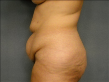 Tummy Tuck Before Photo by Ellen Janetzke, MD; Bloomfield Hills, MI - Case 23852