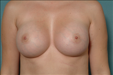 Breast Augmentation After Photo by Ellen Janetzke, MD; Bloomfield Hills, MI - Case 23853