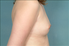Breast Augmentation Before Photo by Ellen Janetzke, MD; Bloomfield Hills, MI - Case 23853
