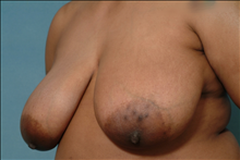 Breast Reduction Before Photo by Ellen Janetzke, MD; Bloomfield Hills, MI - Case 23856