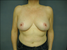 Breast Reduction After Photo by Ellen Janetzke, MD; Bloomfield Hills, MI - Case 23857