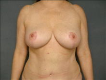 Breast Reduction After Photo by Ellen Janetzke, MD; Bloomfield Hills, MI - Case 23860