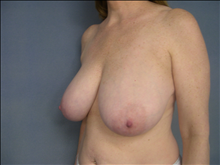 Breast Reduction Before Photo by Ellen Janetzke, MD; Bloomfield Hills, MI - Case 23860