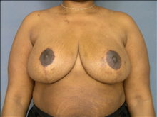 Breast Reduction After Photo by Ellen Janetzke, MD; Bloomfield Hills, MI - Case 23861