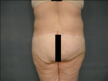 Body Contouring After Photo by Ellen Janetzke, MD; Bloomfield Hills, MI - Case 23863