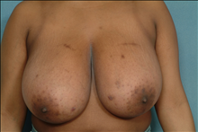 Breast Reduction Before Photo by Ellen Janetzke, MD; Bloomfield Hills, MI - Case 23865