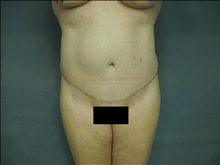 Tummy Tuck After Photo by Ellen Janetzke, MD; Bloomfield Hills, MI - Case 23868