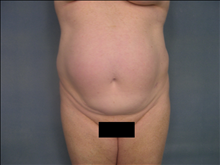 Tummy Tuck Before Photo by Ellen Janetzke, MD; Bloomfield Hills, MI - Case 23868