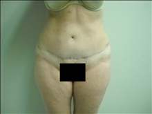 Tummy Tuck After Photo by Ellen Janetzke, MD; Bloomfield Hills, MI - Case 23870
