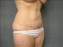 Tummy Tuck After Photo by Ellen Janetzke, MD; Bloomfield Hills, MI - Case 23870