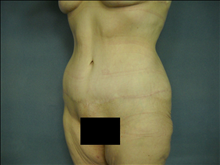 Tummy Tuck After Photo by Ellen Janetzke, MD; Bloomfield Hills, MI - Case 23871