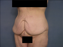 Tummy Tuck Before Photo by Ellen Janetzke, MD; Bloomfield Hills, MI - Case 23871