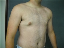 Male Breast Reduction After Photo by Ellen Janetzke, MD; Bloomfield Hills, MI - Case 23950