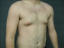 Male Breast Reduction Before Photo by Ellen Janetzke, MD; Bloomfield Hills, MI - Case 23950