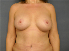 Breast Augmentation After Photo by Ellen Janetzke, MD; Bloomfield Hills, MI - Case 23951