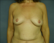 Breast Augmentation Before Photo by Ellen Janetzke, MD; Bloomfield Hills, MI - Case 23951