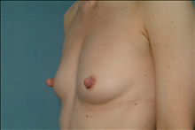 Breast Augmentation Before Photo by Ellen Janetzke, MD; Bloomfield Hills, MI - Case 24458
