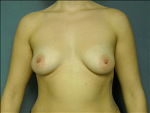 Breast Augmentation Before Photo by Ellen Janetzke, MD; Bloomfield Hills, MI - Case 24461