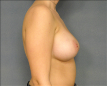 Breast Augmentation After Photo by Ellen Janetzke, MD; Bloomfield Hills, MI - Case 24461