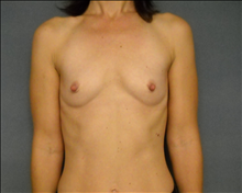 Breast Augmentation Before Photo by Ellen Janetzke, MD; Bloomfield Hills, MI - Case 24462