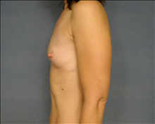 Breast Augmentation Before Photo by Ellen Janetzke, MD; Bloomfield Hills, MI - Case 24462