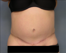 Tummy Tuck After Photo by Ellen Janetzke, MD; Bloomfield Hills, MI - Case 24463