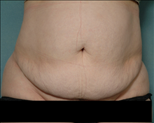 Tummy Tuck Before Photo by Ellen Janetzke, MD; Bloomfield Hills, MI - Case 24463