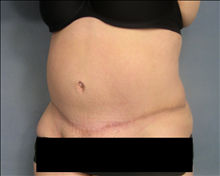 Tummy Tuck After Photo by Ellen Janetzke, MD; Bloomfield Hills, MI - Case 24463