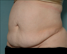 Tummy Tuck Before Photo by Ellen Janetzke, MD; Bloomfield Hills, MI - Case 24463