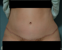 Tummy Tuck After Photo by Ellen Janetzke, MD; Bloomfield Hills, MI - Case 24464