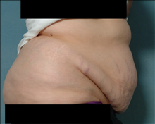 Tummy Tuck Before Photo by Ellen Janetzke, MD; Bloomfield Hills, MI - Case 24464