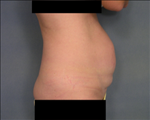 Tummy Tuck Before Photo by Ellen Janetzke, MD; Bloomfield Hills, MI - Case 24465