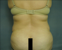 Liposuction After Photo by Ellen Janetzke, MD; Bloomfield Hills, MI - Case 24466