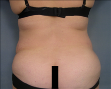 Liposuction Before Photo by Ellen Janetzke, MD; Bloomfield Hills, MI - Case 24466