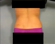 Liposuction After Photo by Ellen Janetzke, MD; Bloomfield Hills, MI - Case 24468