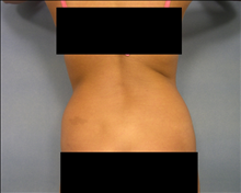 Liposuction Before Photo by Ellen Janetzke, MD; Bloomfield Hills, MI - Case 24468