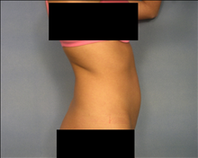 Liposuction Before Photo by Ellen Janetzke, MD; Bloomfield Hills, MI - Case 24468