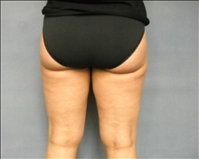 Liposuction After Photo by Ellen Janetzke, MD; Bloomfield Hills, MI - Case 24469